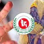 পুরান ঢাকায় হাম প্রাদুর্ভাবে আক্রান্ত শিশুদের চিকিৎসা চলছে